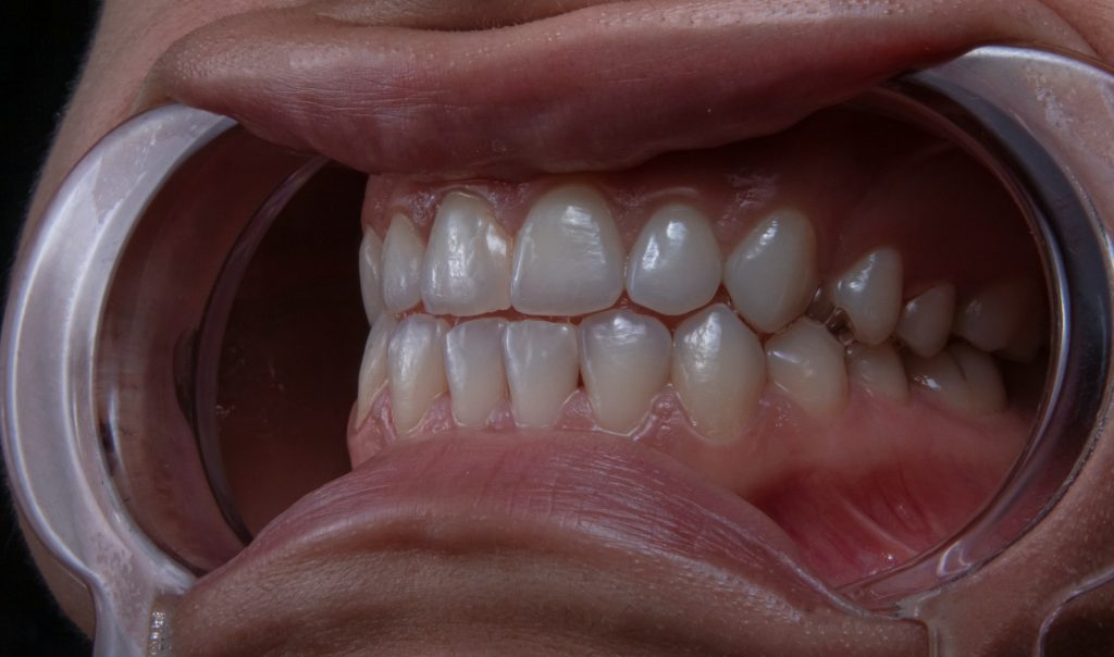 whitening foam
