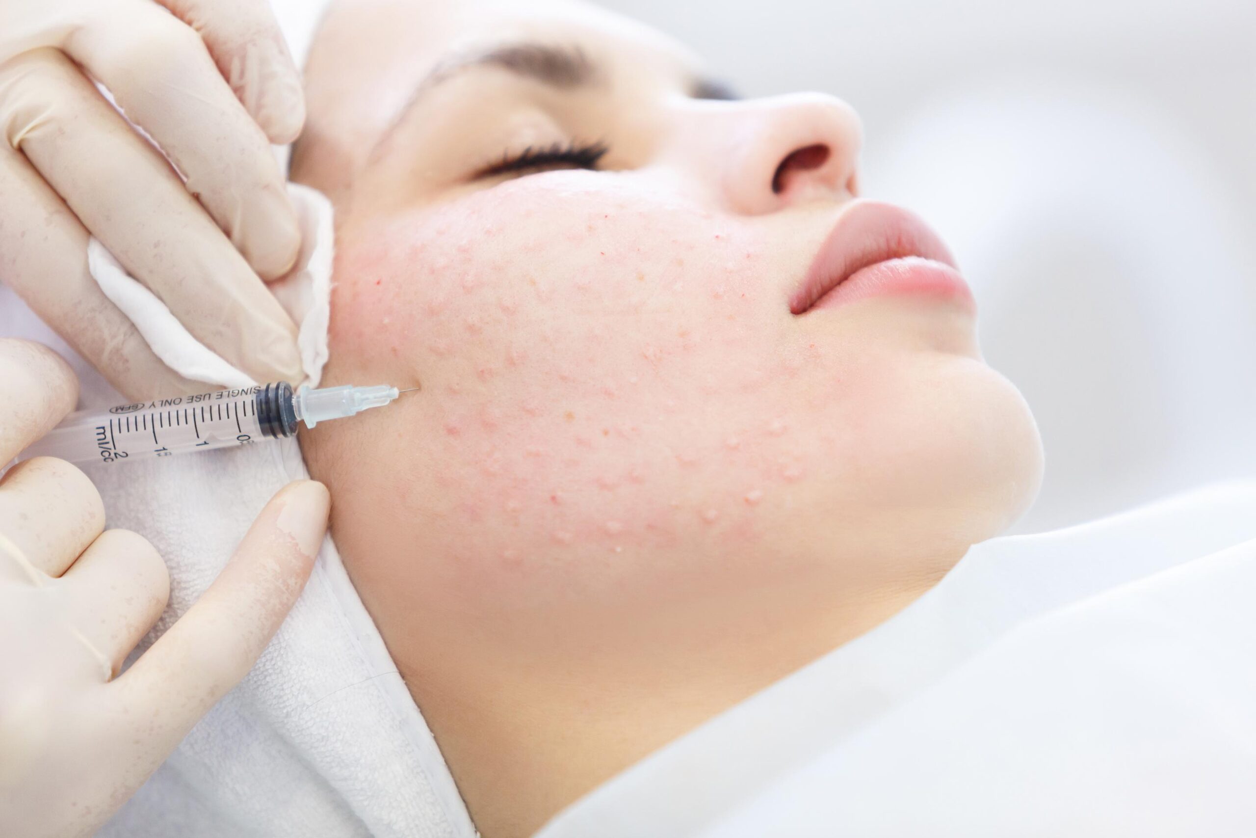 Mesotherapie voor de huid